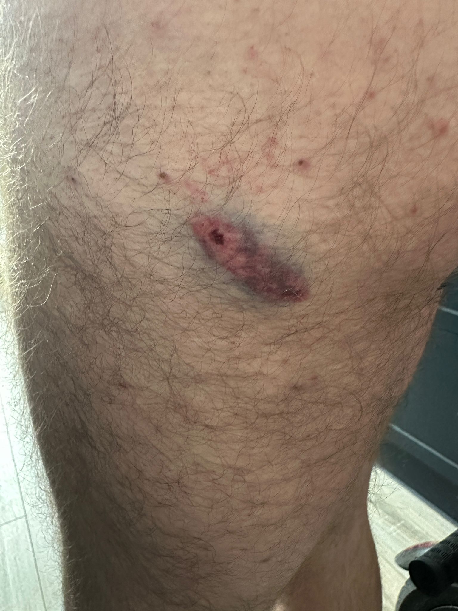 Bitten By Dog